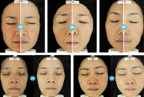 ویژگی های ژل کربوکسی ریب اسکین CO2 :