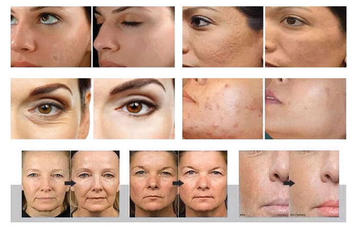 ویژگی‌های فنی دستگاه آراف فرکشنال سوزنی کریستال لایت